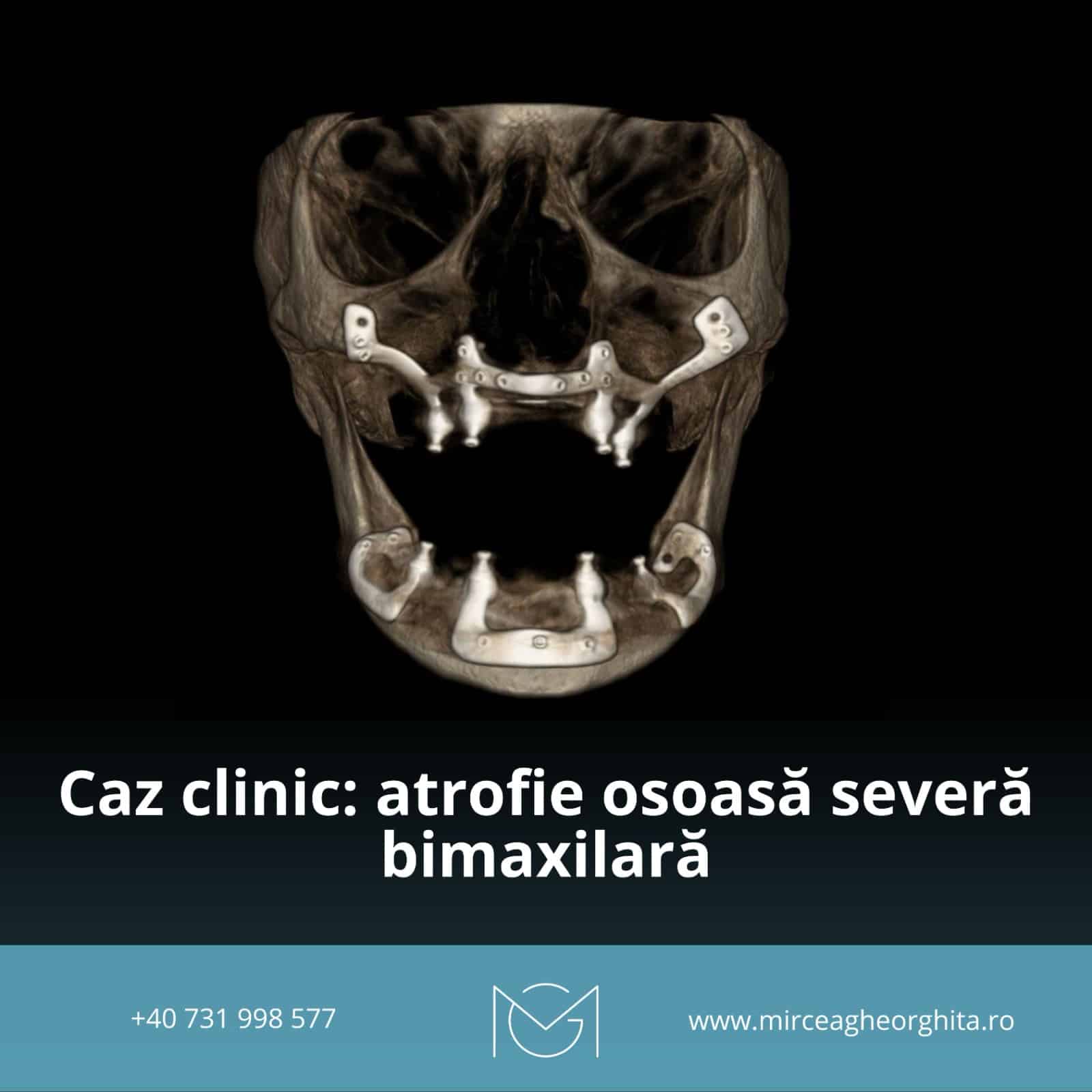 Atrofie osoasa severă bimaxilară